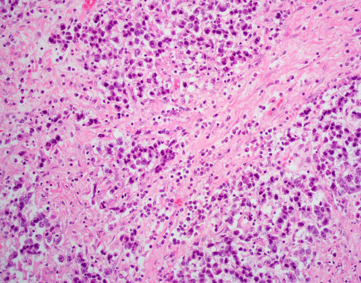 Dysgerminoma Germ Cell Ovarian Tumor