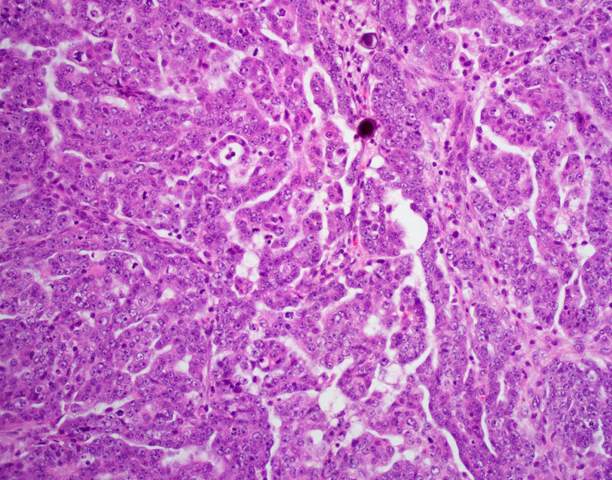 High-Grade Serous Carcinoma Epithelial Ovarian Tumor
