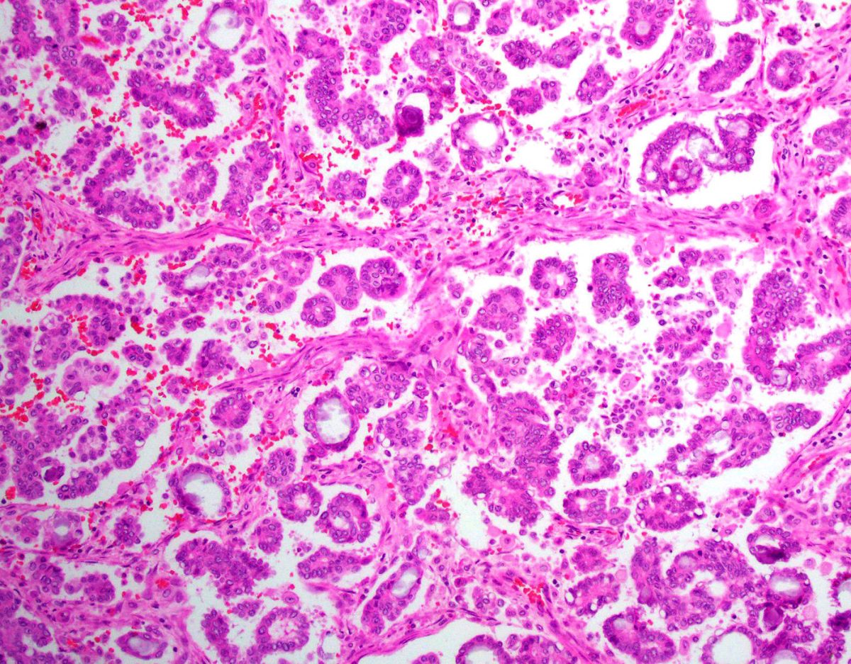 Low-Grade Serous Carcinoma Epithelial Tumor