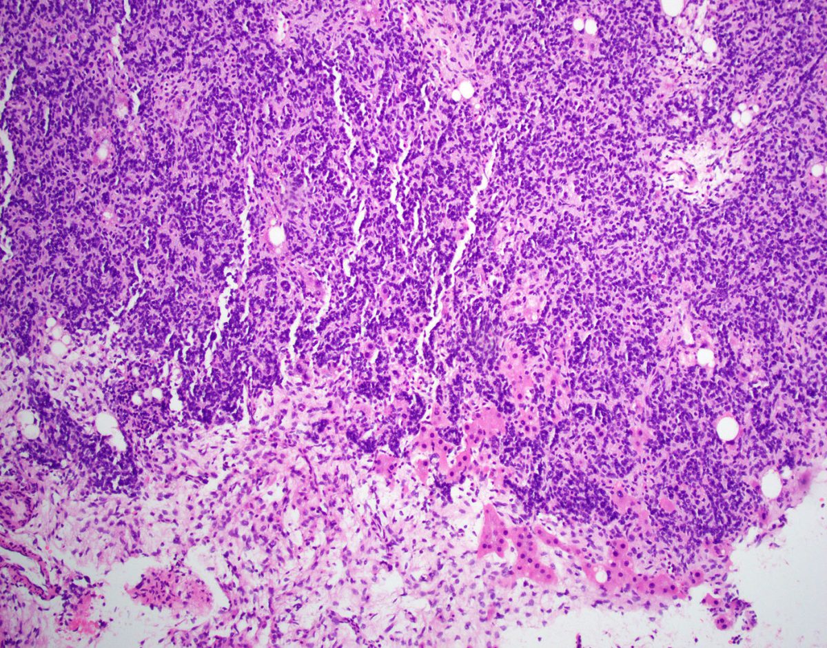 Sertoli-Leydig Cell Ovarian Tumor