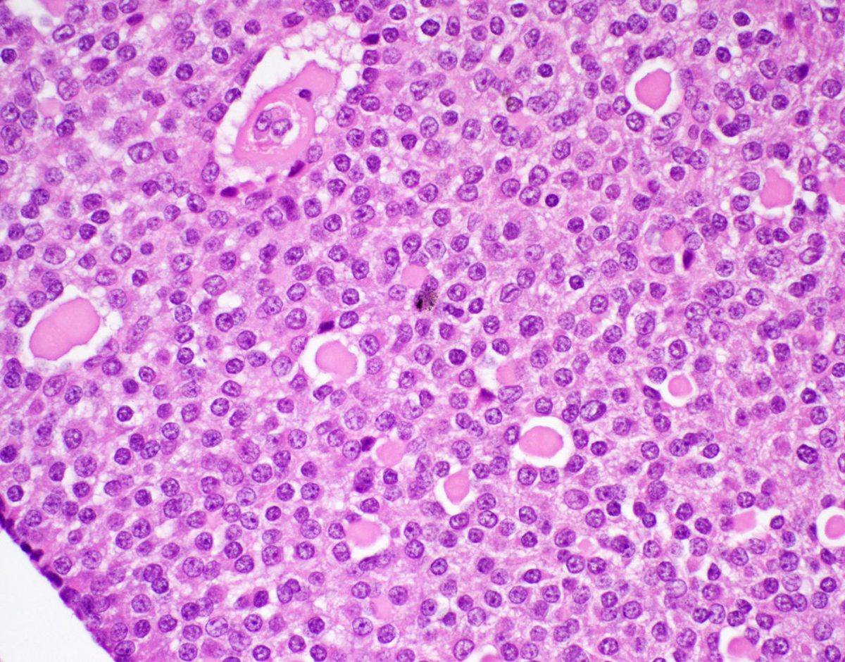 Adult Granulosa Cell Ovarian Tumor