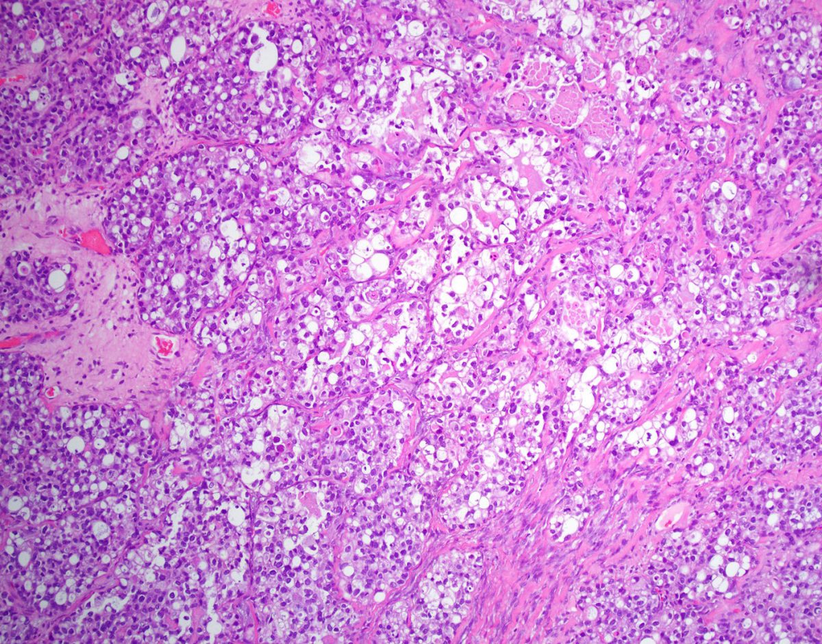 Clear Cell Carcinoma Epithelial Tumor