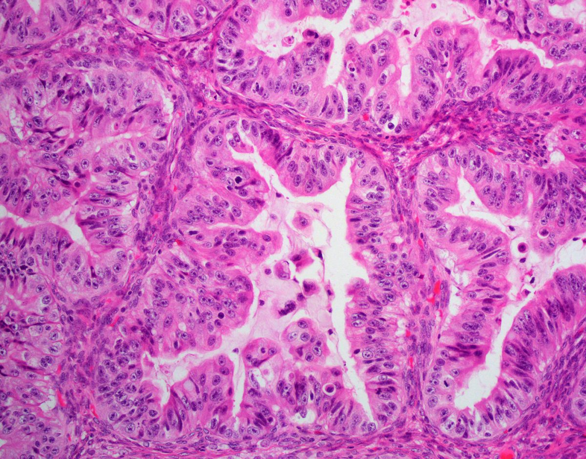 Mucinous Carcinoma Epithelial Tumor