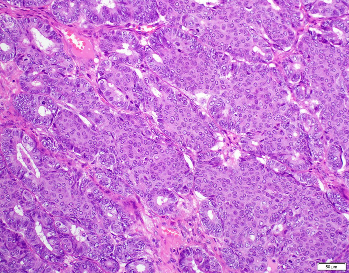 Ovarian Endometrioid Carcinoma Epithelial Tumor