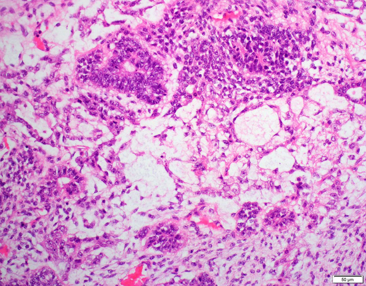 Yolk Sac Germ Cell Ovarian Tumor