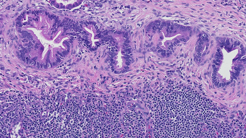 Well Differentiated adenocarcinoma