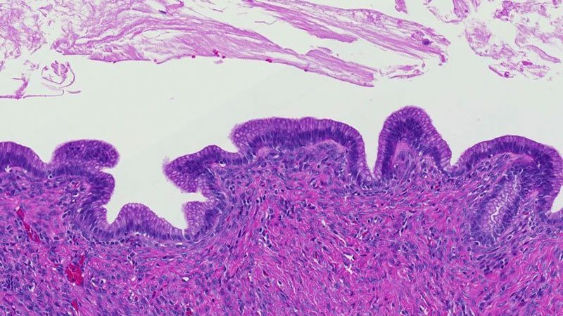 Mucinous cystic neoplasm