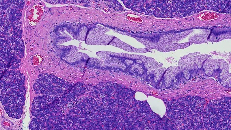 Pancreatic intraepithelial neoplasia