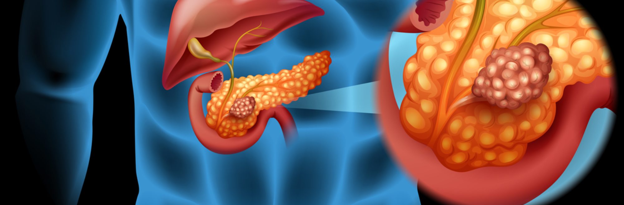 Pancreas cancer illustration