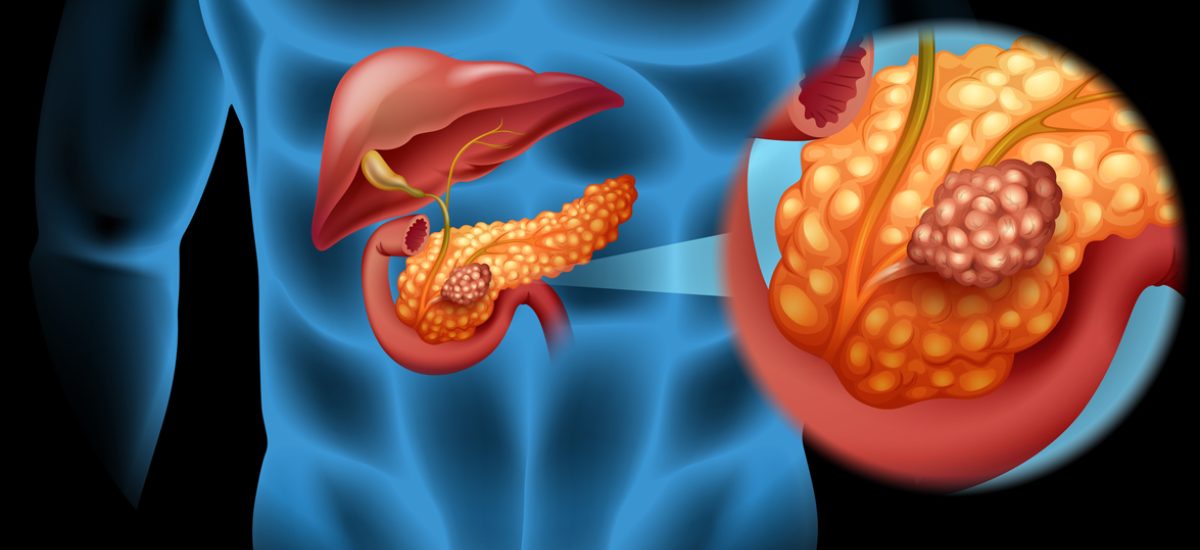 Pancreas cancer illustration