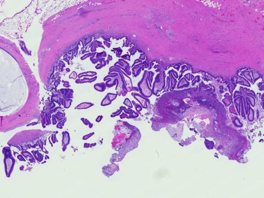 Intraductalis papilláris mucinos neoplazma - Hasnyálmirigyrákos diagnózis