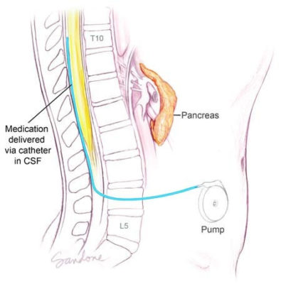 intrathecal anesthesia illustration by Corinne Sandone