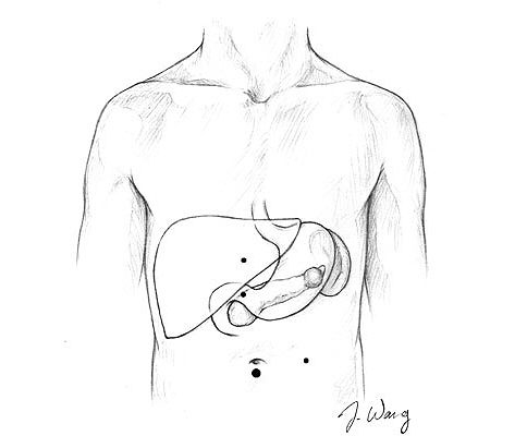 Laparoscopic Sketch