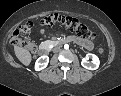 Neuroendocrine tumor CT