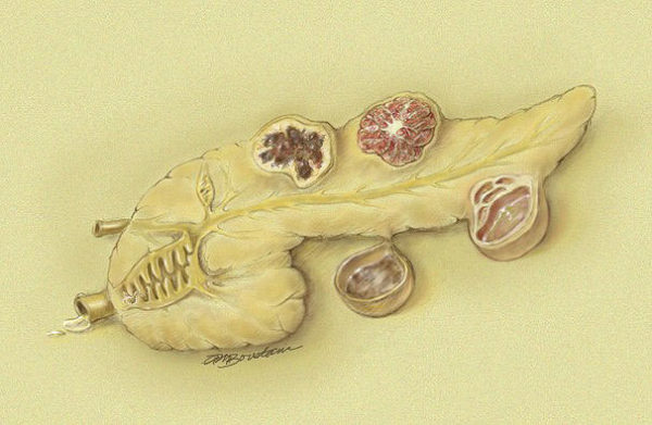 Pancreas cyst illustration