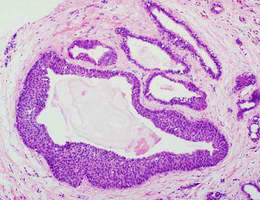 Classification of PanIN Lesions in the Pancreas (2022)