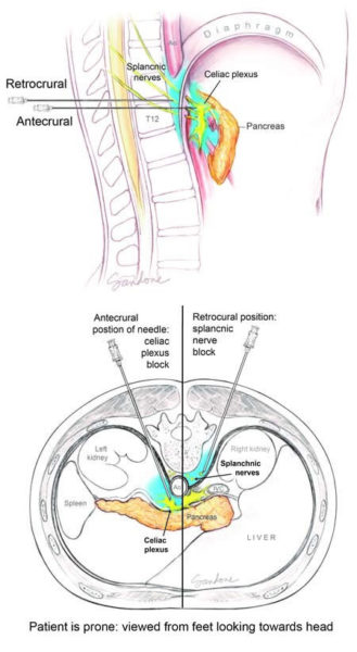 celiac plexus nerve block - illustration by Corinne Sandone