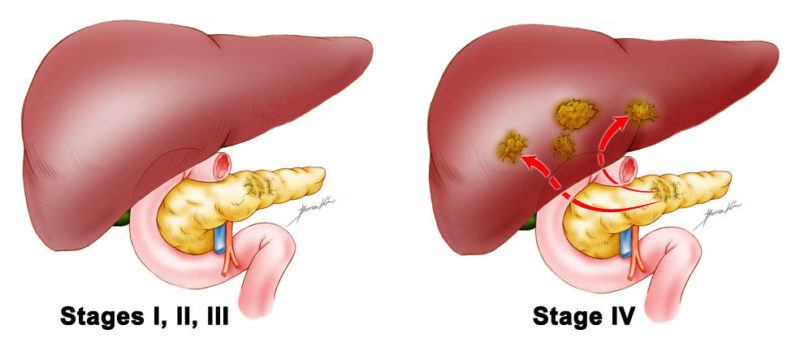 Pancreatic cancer with liver lesions - sanchi.ro