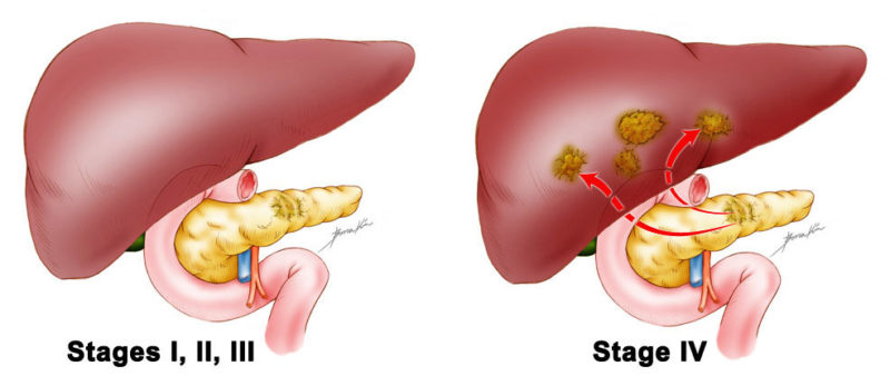 how long does end stage pancreatic cancer last