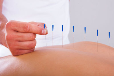 Acupuncture