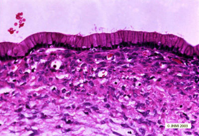 Mucinous Cystic Neoplasm - Histological