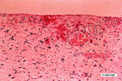Pseudocyst - Histological
