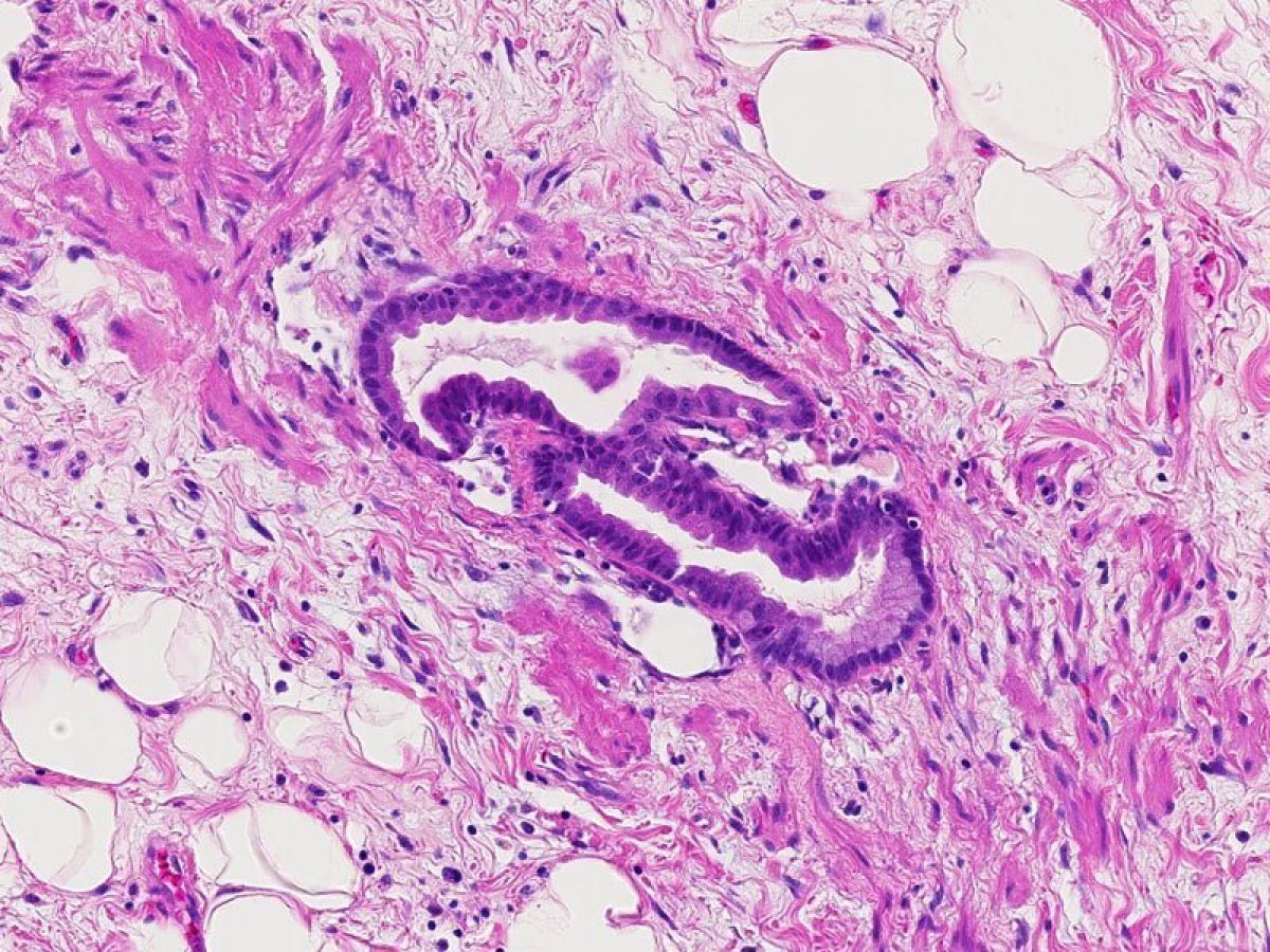 Adenocarcinoma