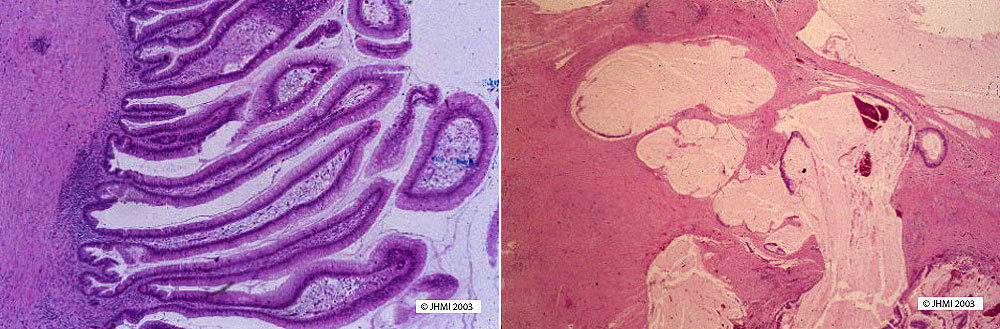 IPMN - Histological