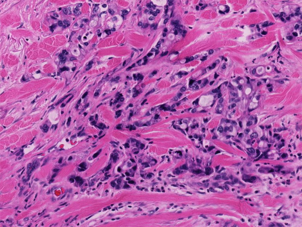Poorly differentaited adenocarcinoma