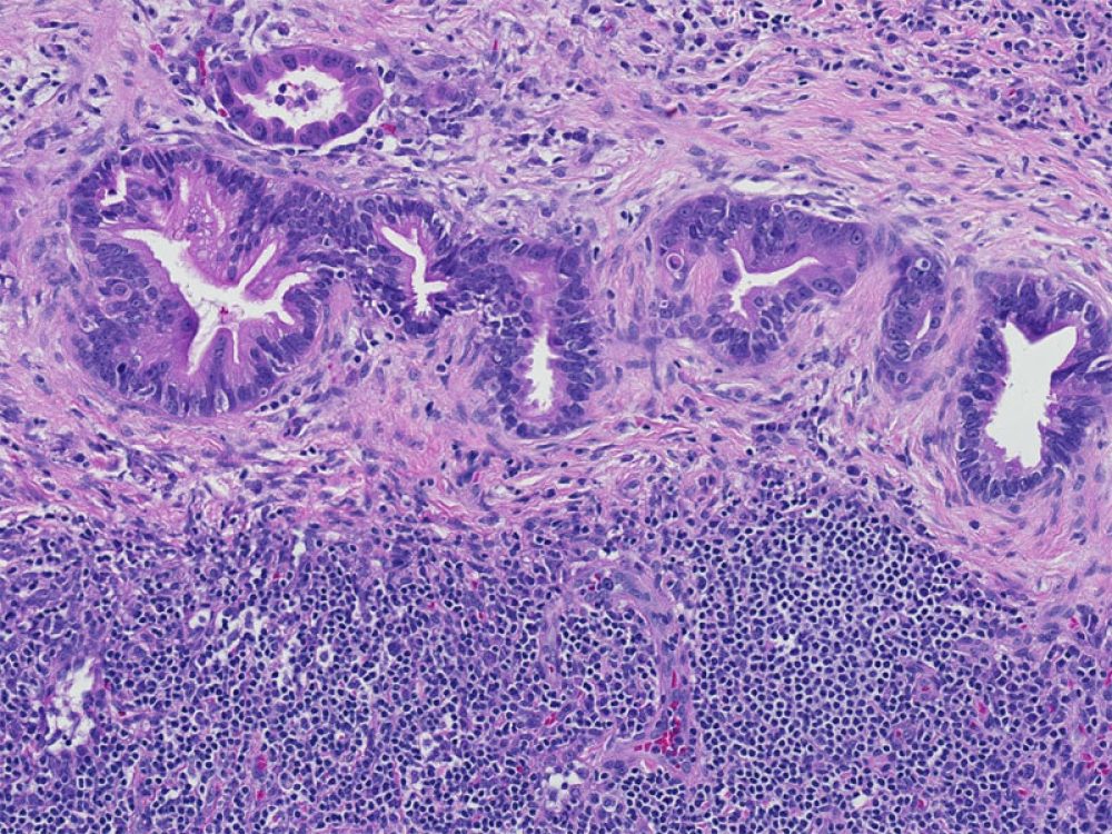 Well Differentiated adenocarcinoma