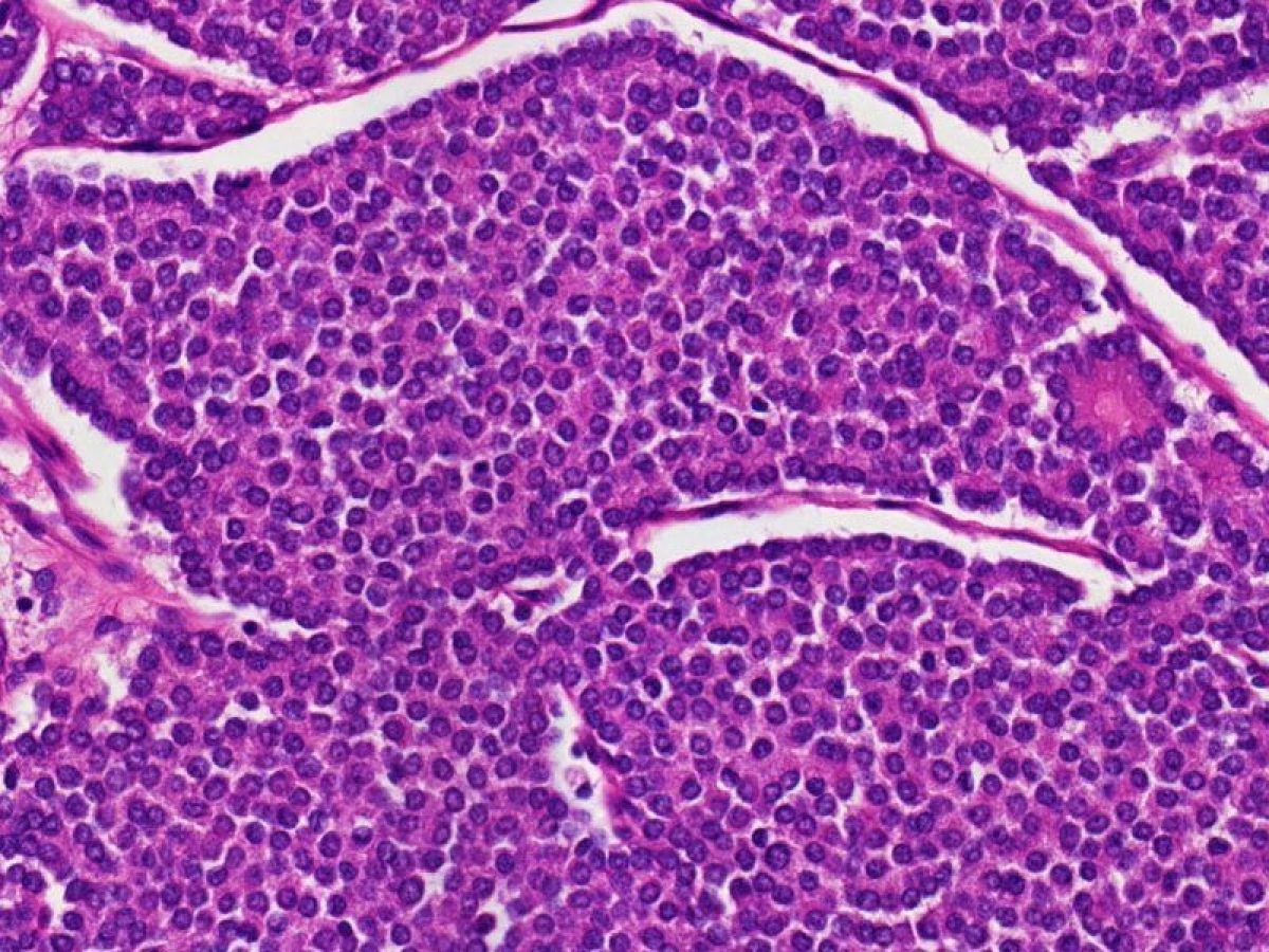 Acinar cell carcinoma