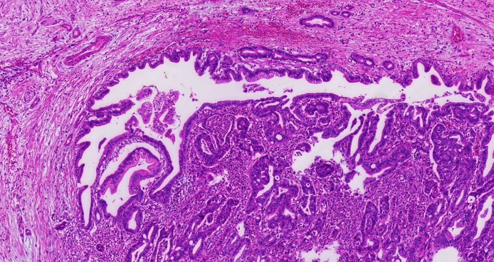 Cancerization of Ducts 1