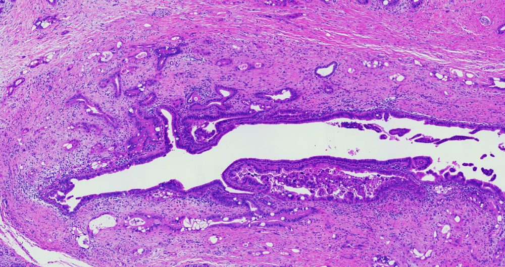 Cancerization of Ducts 2