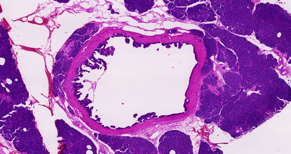 Cancerization of Ducts 3
