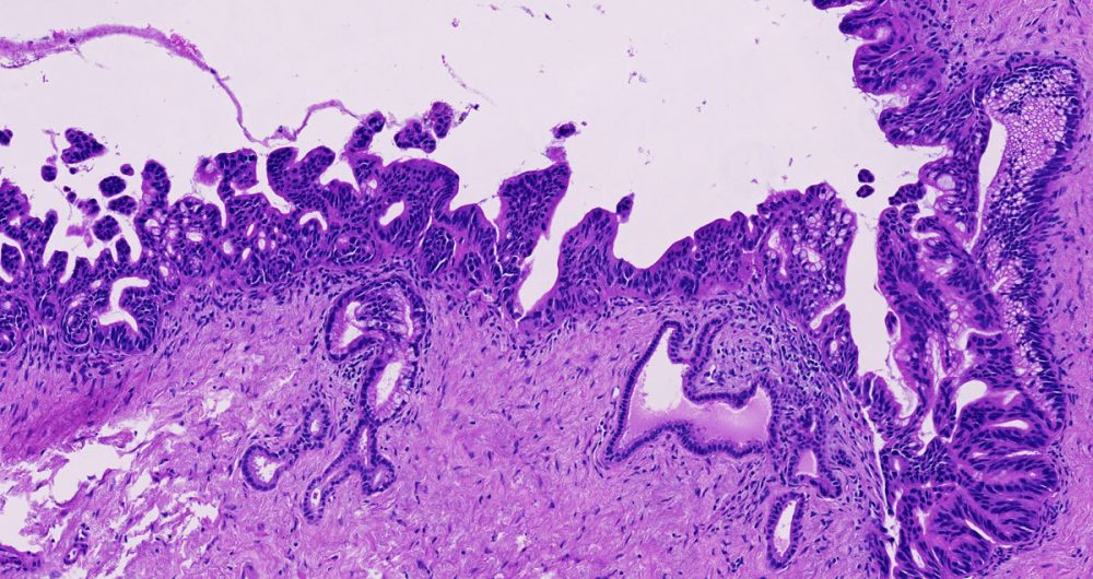 Cancerization of Ducts 4