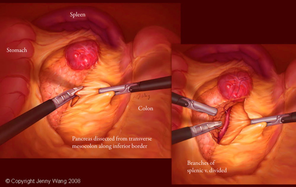 Pancreatic surgery