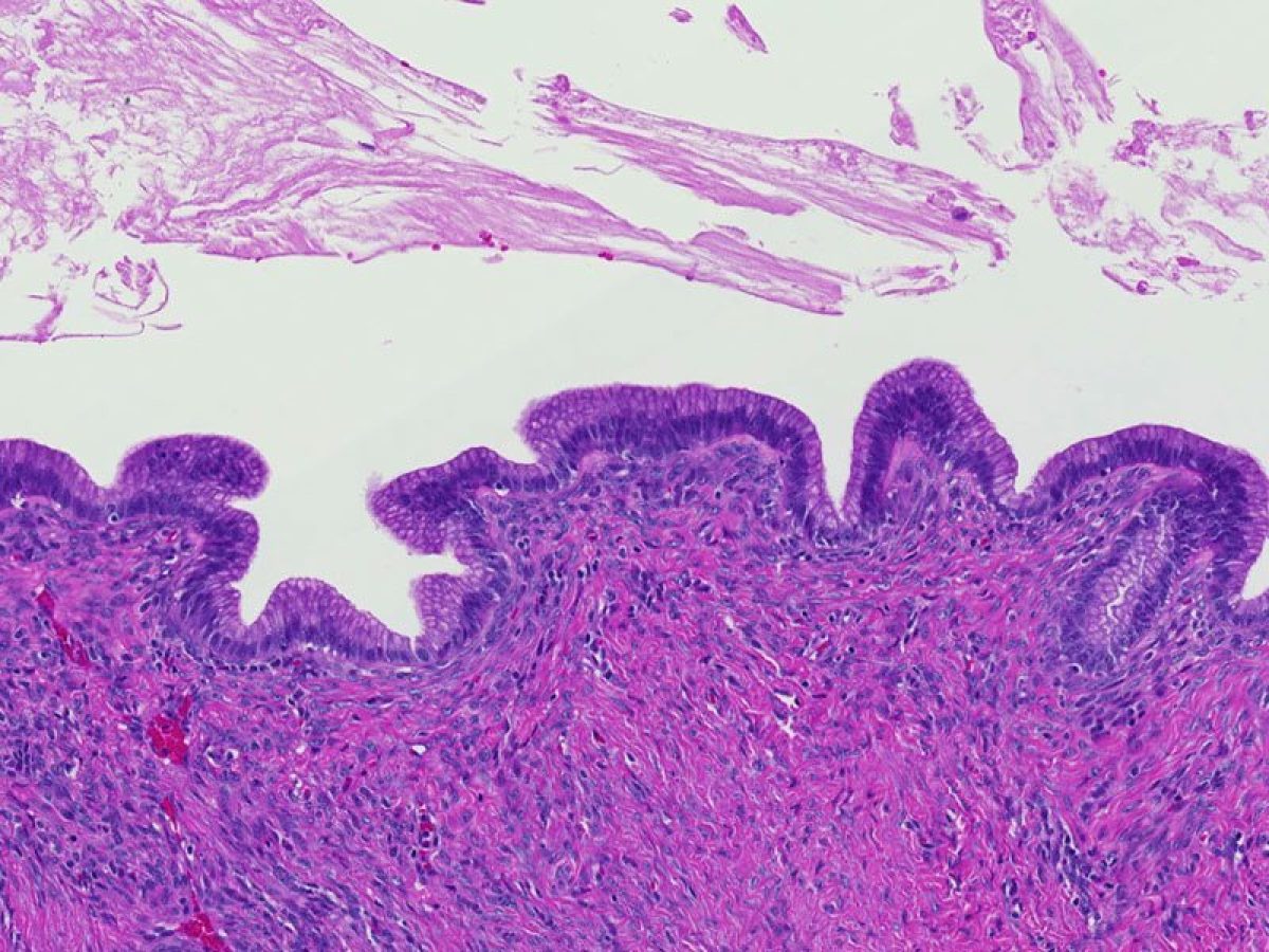 Mucinous cystic neoplasm