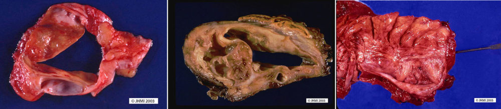 Mucinous Cystic Neoplasm - Gross