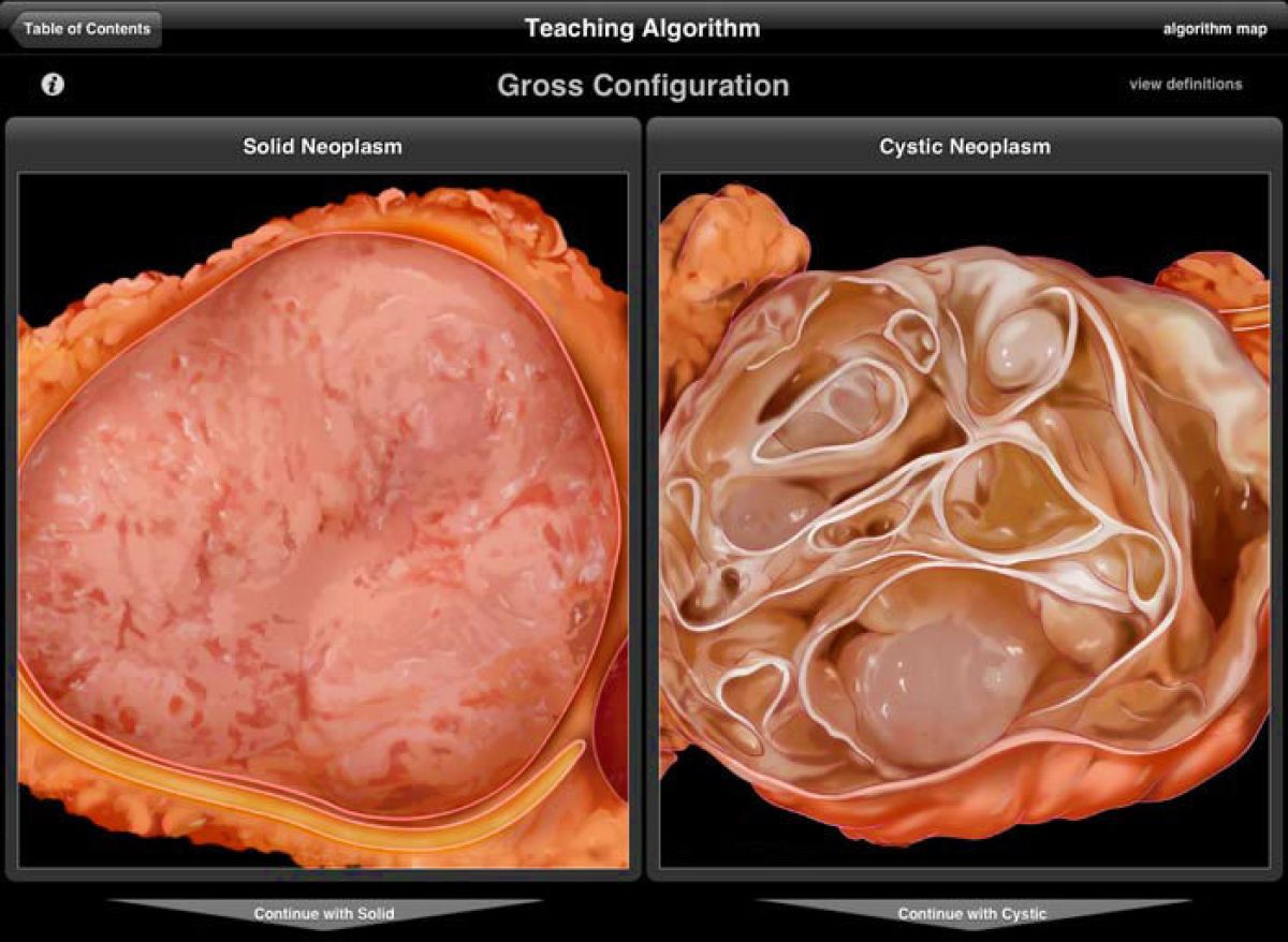 Pancreas ipad app screenshot