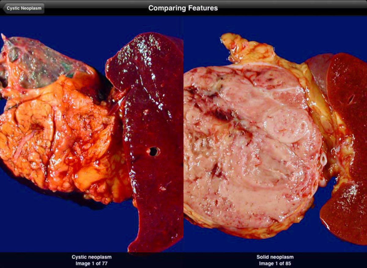 Pancreas ipad app screenshot
