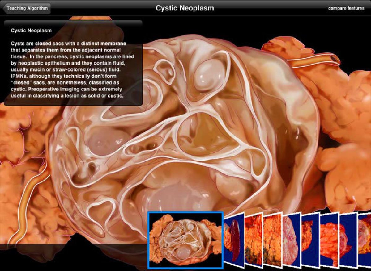 Pancreas ipad app screenshot