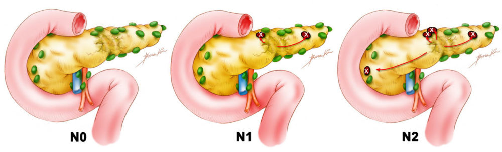 Pancreas Lymph Nodes Illustrations by Bona Kim
