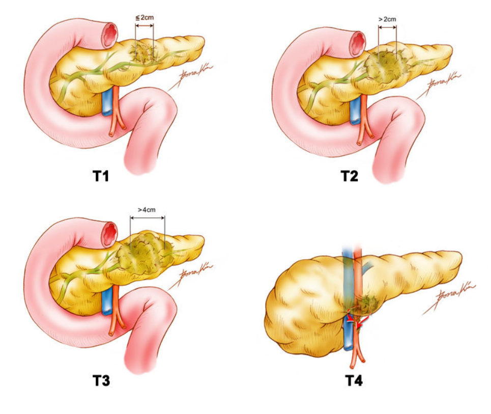 Pancreas Tumor Illustrations by Bona Kim