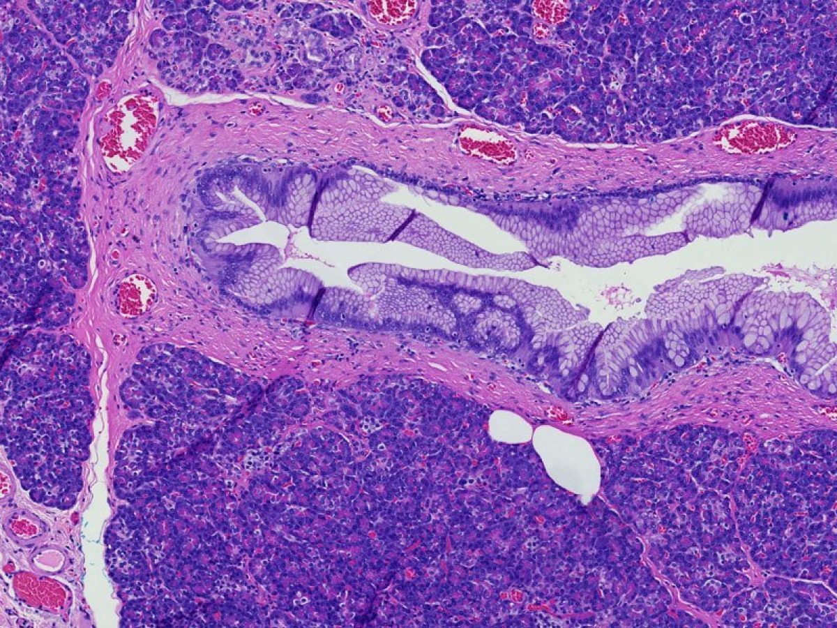 Pancreatic intraepithelial neoplasia