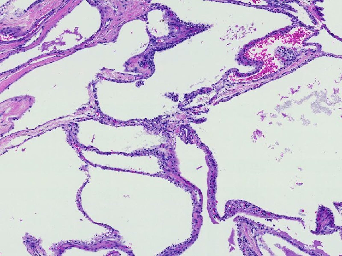 Serous cystadenoma