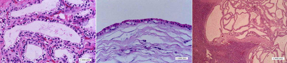 Serous Cystic Neoplasm - Histological