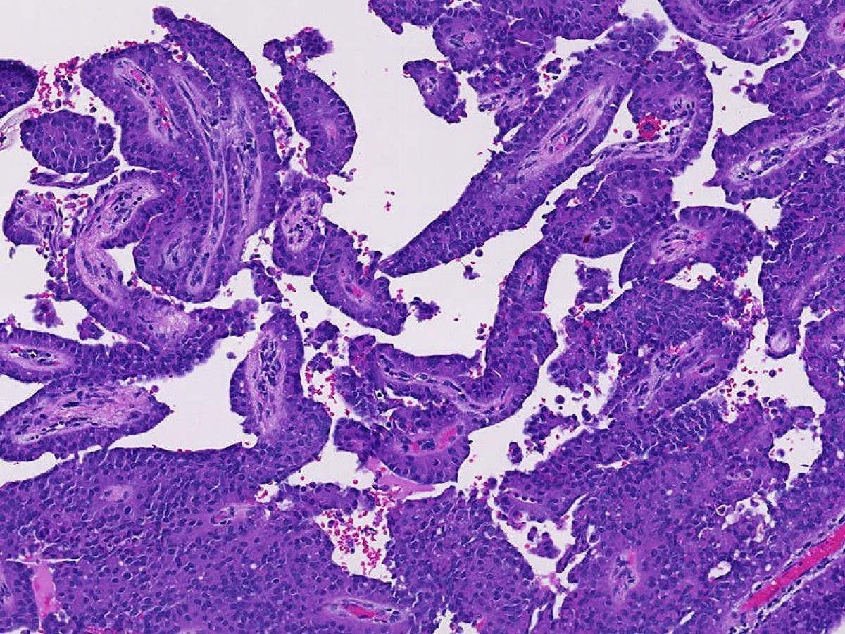 Solid pseudopapillary neoplasm