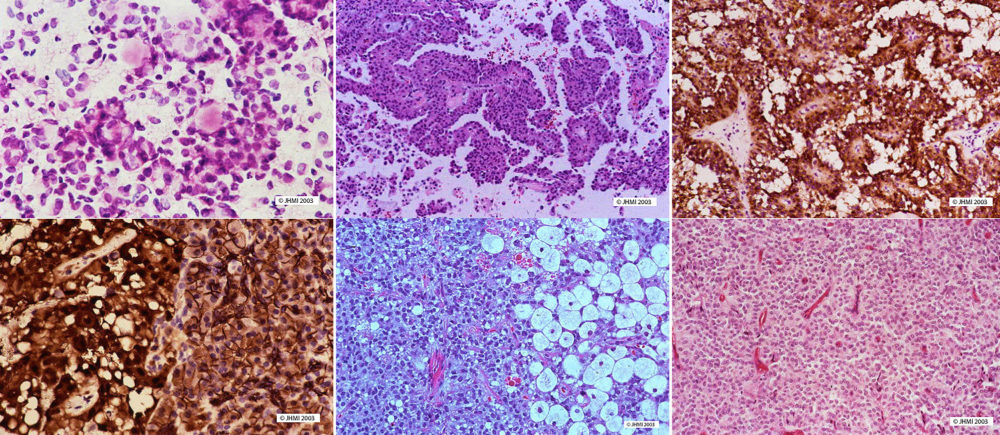 Solid-pseudopapillary Neoplasm - Histological