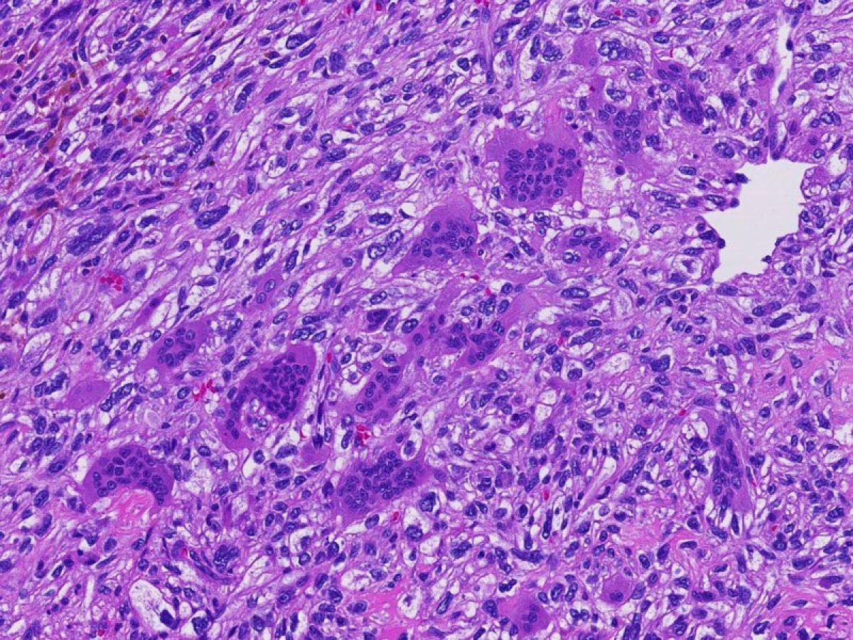 Undifferentiated carcinoma with osteoclast like giant cells