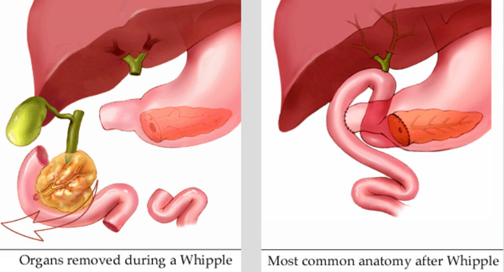 Whipple procedure illustrations